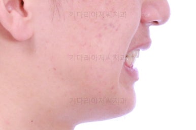 부산청소년치아교정