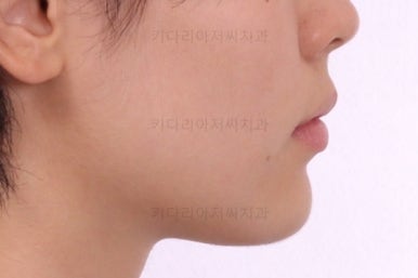 부산연산동치아교정