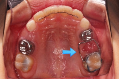 부산어린이반대교합