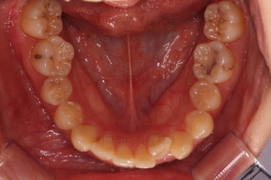 부산돌출입교정