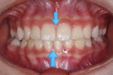 부산치아교정잘하는곳
