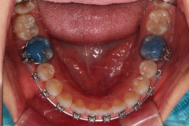 부산구순구개열