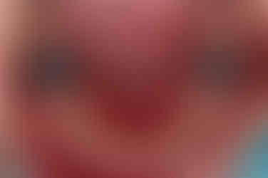 부산구순구개열