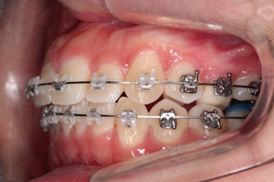부산비대칭교정