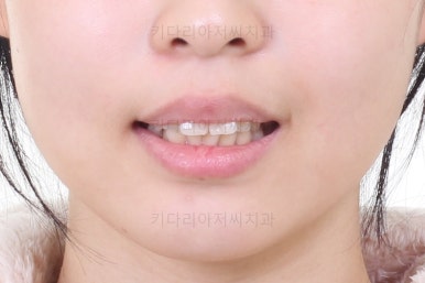 부산클리피씨교정