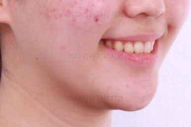 부산비발치교정