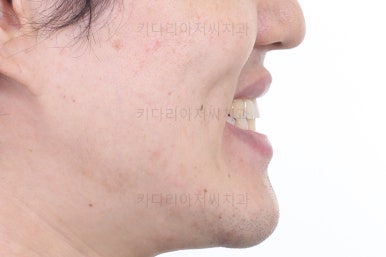 부산비수술교정