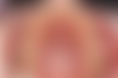 부산덧니교정