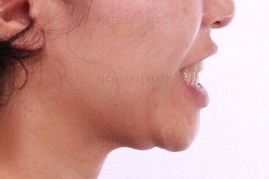 부산연산동교정치과