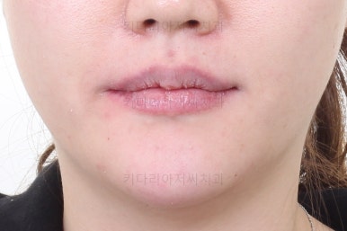 부산개방교합