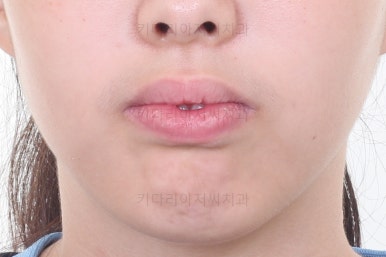 부산투명교정