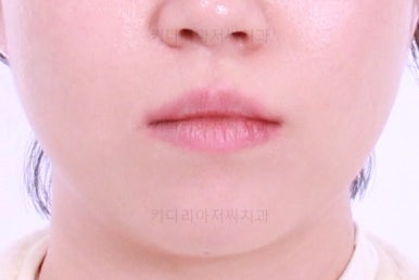 부산치아교정잘하는곳