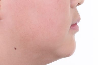 부산비발치교정