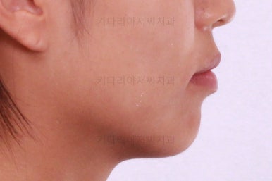 부산연산역치아교정