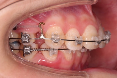연산동치아교정