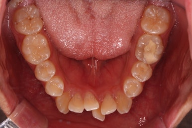 부산청소년치아교정