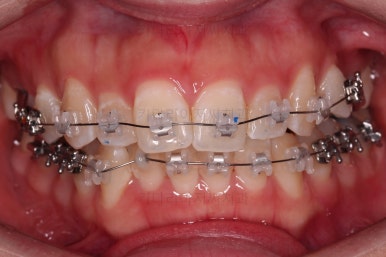 부산비대칭교정