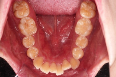 부산돌출입교정