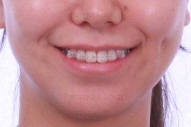 부산교정잘하는치과