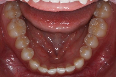 부산매복치아교정