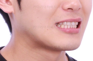 연산동치아교정