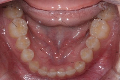 부산매복치아교정
