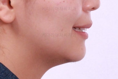 부산사랑니교정