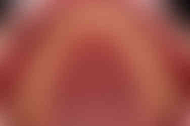 부산연산동사랑니발치