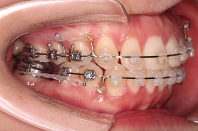 부산사랑니교정