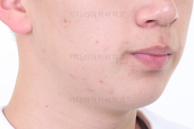 부산청소년치아교정