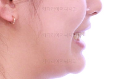 부산안면비대칭