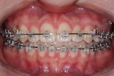 부산치아교정잘하는곳