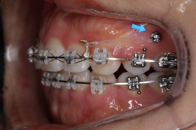부산연산동교정치과