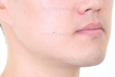 부산비수술교정