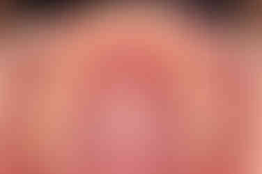 부산앞니벌어짐교정