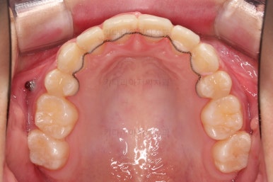 연산동치아교정