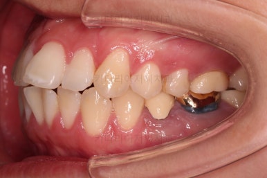 부산사랑니교정