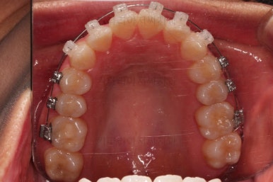 부산교정잘하는치과