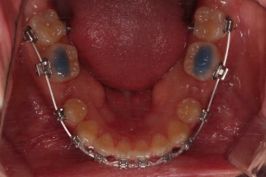 동래구치아교정