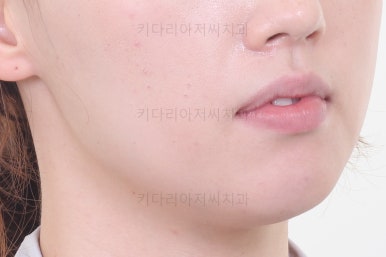 부산비대칭교정