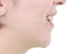 부산임플란트