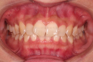 부산앞니부분교정