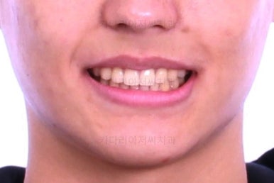 부산연산동치아교정