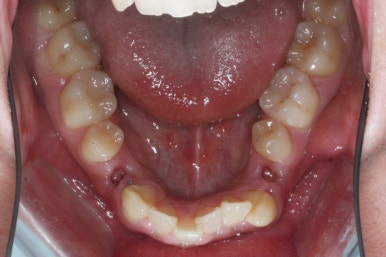 부산구순구개열