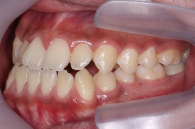 부산주걱턱교정