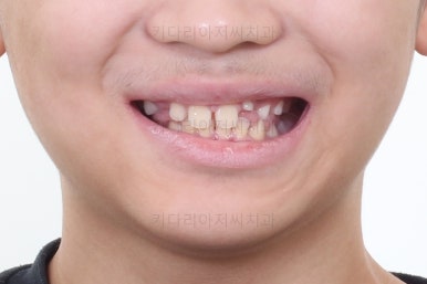 부산어린이돌출입교정