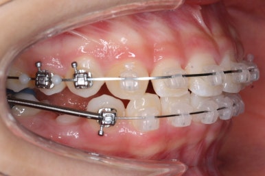 부산치아교정잘하는곳