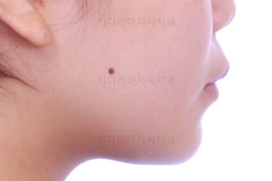 부산앞니벌어짐교정