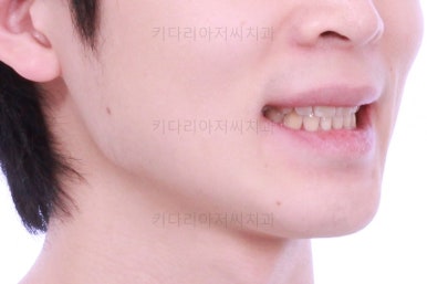 부산돌출입교정