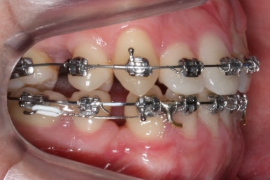 부산구순구개열